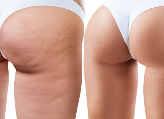 Cellulite Reduction