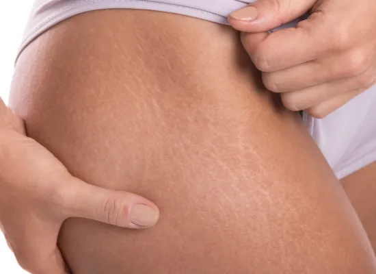 Stretch Mark Removal